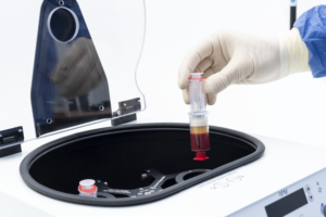 次世代PRPとして注目されるAPS療法