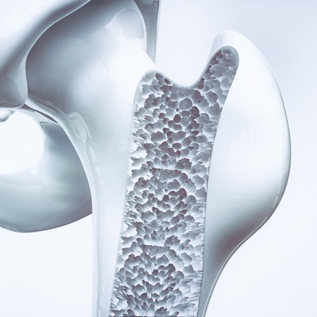 骨粗鬆症