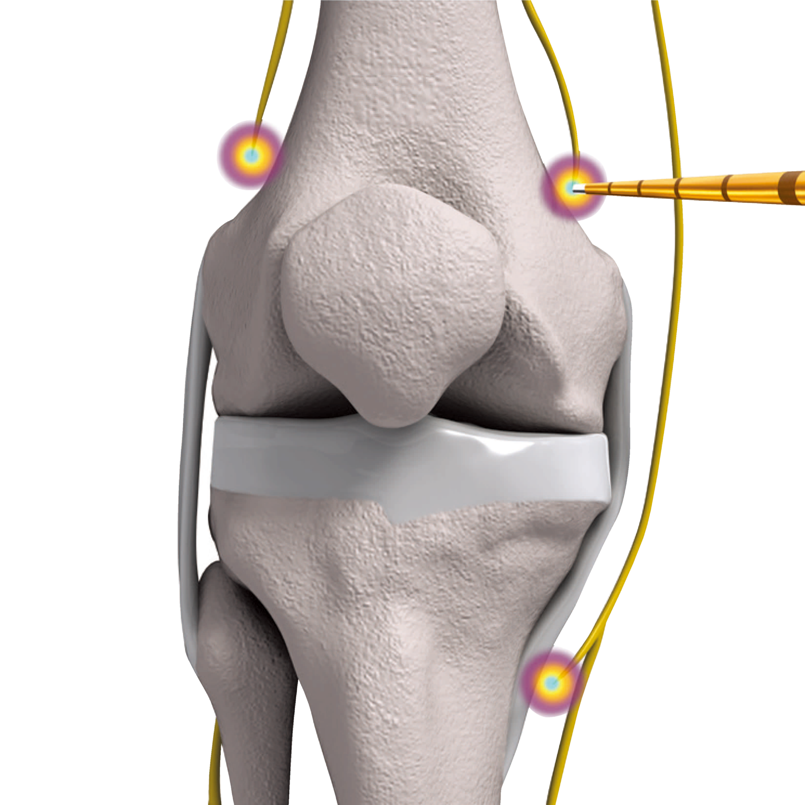針を刺す部分に局所麻酔